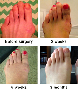 Four images of a bunion: Before surgery, after 2 weeks, after 6 weeks, and after 3 months