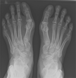 Image of x-ray showing feet with bunion