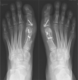 Image of x-ray showing feet with bunion corrected using screw fixation